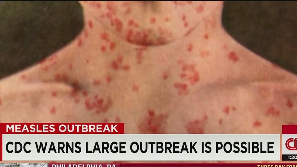 Measles