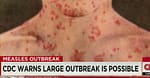 Measles