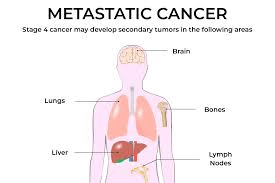 Metastatic cancer